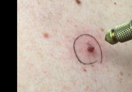 Using Liquid Nitrogen for Skin Tag Removal