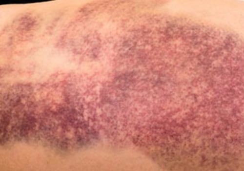 Reducing Swelling and Bruising After Mole Removal Surgery