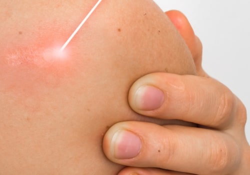 Freezing Mole Removal Aftercare: A Comprehensive Guide